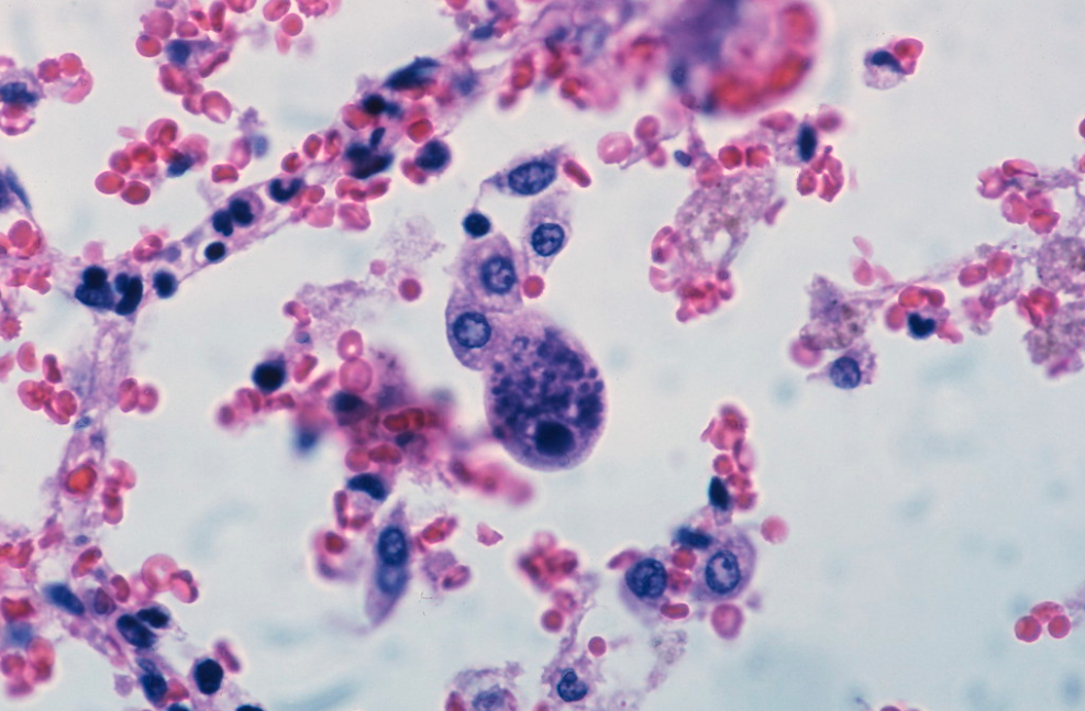 Yale Rosen, Cytomegalovirus infection 
