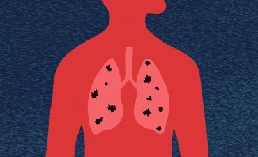 міфи про туберкульоз туберкульоз легень