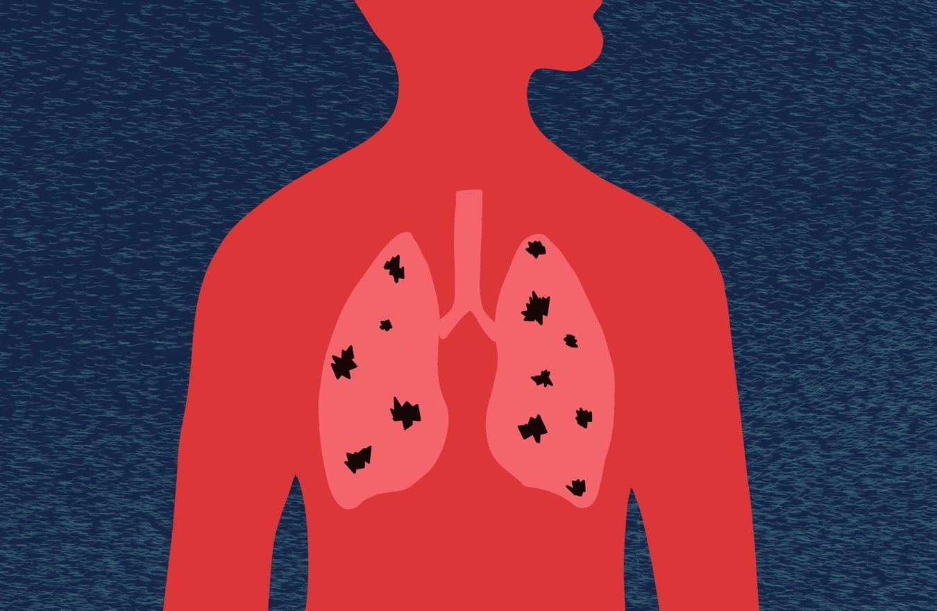 міфи про туберкульоз туберкульоз легень
