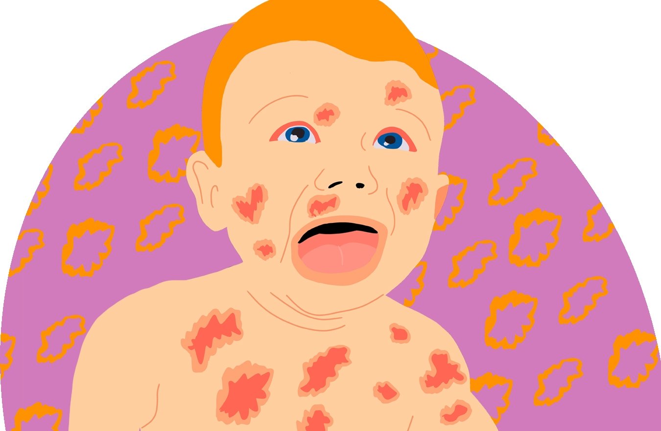 шкіра дерматологія діти педіатрія