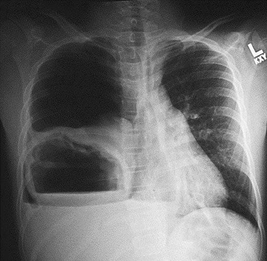 Рентгенографія грудної клітки з абсцесом легені після множинних стафілококових пневмоній