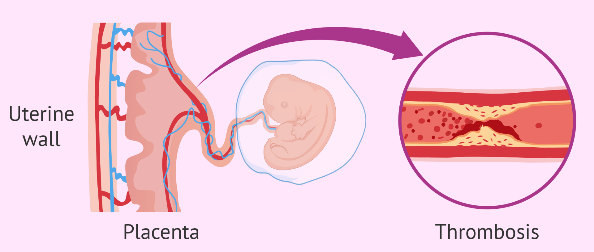 Antiphospholipid Syndrome and Pregnancy