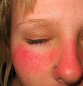 Acute sunburn of face after a soccer match in a 15 year-old girl.