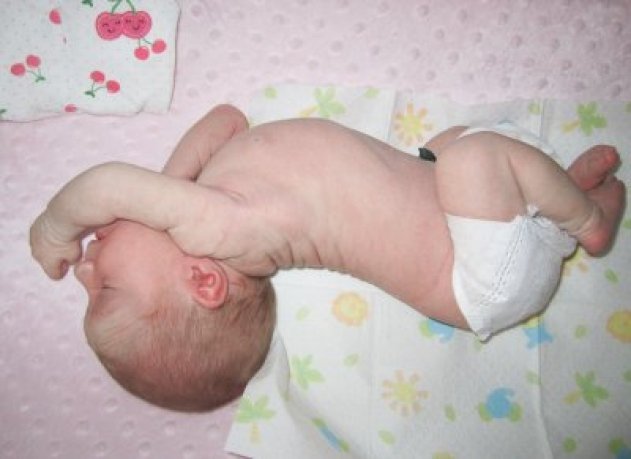 "https://www.infant-acid-reflux-solutions.com/sandifers-syndrome.html"